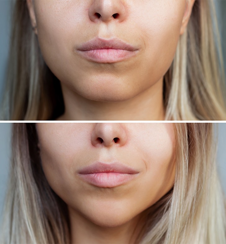 Chin Reduction Surgery Ba kent Hastanesi