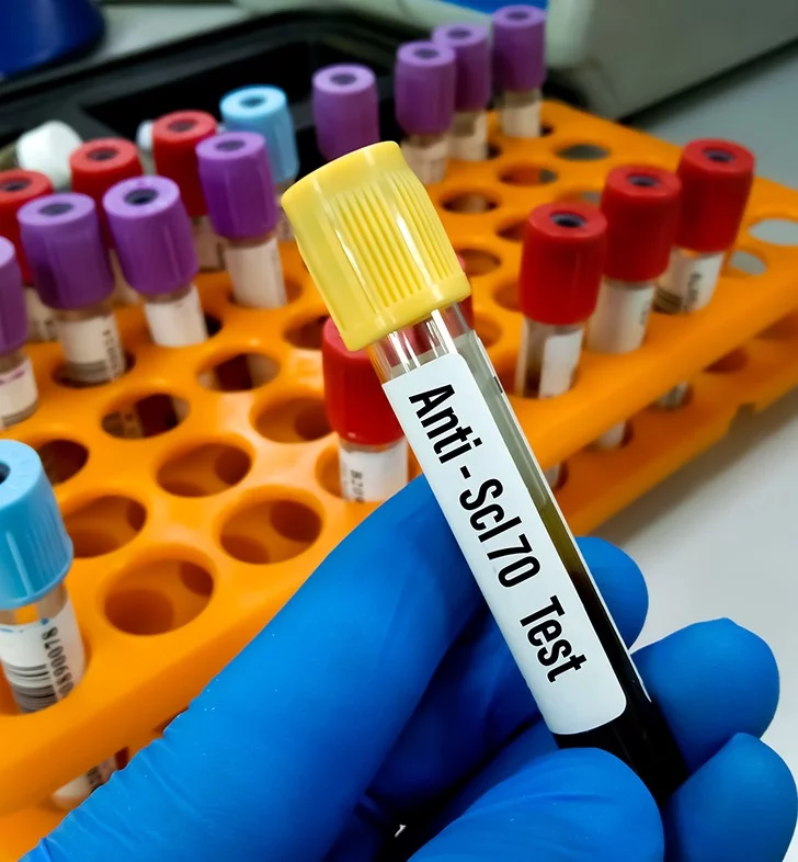 Autoimmune Neutropenia