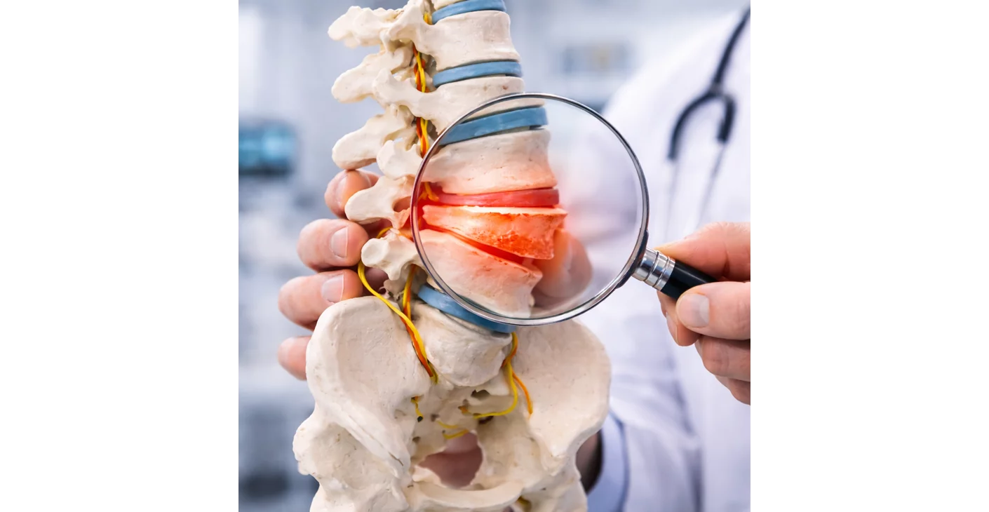  انزلاق الفقرات